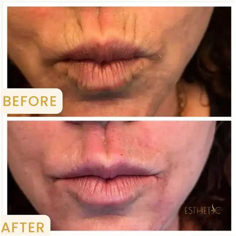 Phoenix Botox At It's Best - Get 5 Free Units At Your First Visit!