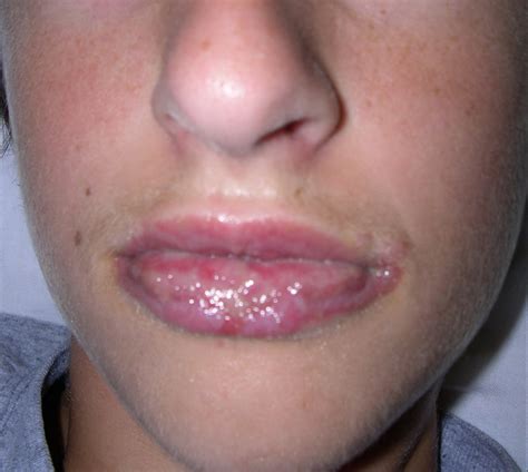 Collection 104+ Pictures Stevens Johnson Syndrome Photos Pictures Excellent