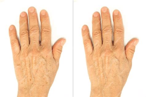 Premium Photo | Age spots on the hands before and after removal using a lightening whitening ...