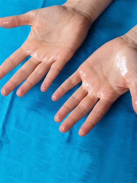 How To Prevent Hyperhidrosis Hands