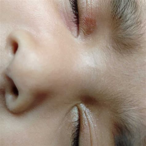 Newborn Has Red Eyelids