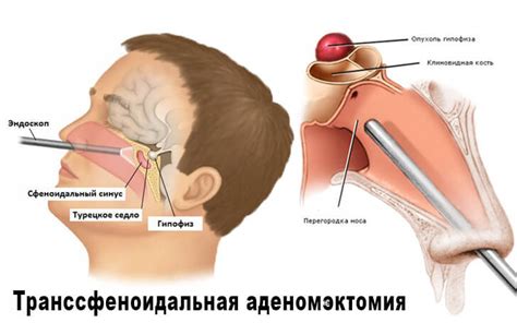Опухоли гипофиза – симптомы у женщин и мужчин, диагностика, лечение.