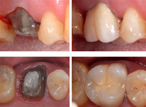 Why A Dentists Suggests A Crown For a Tooth | CAP City Dental