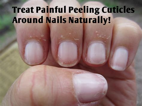 Fingernail Skin Peeling