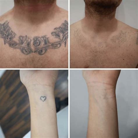 How Expensive Is Tattoo Removal