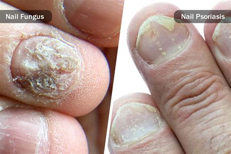 Nail Fungus vs. Nail Psoriasis