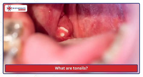What do white patches on tonsils indicate? Learn its signs, causes, and treatment options