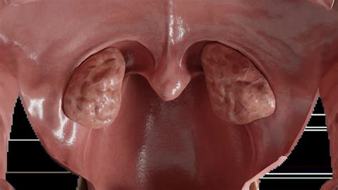 3D Model of Hypertrophy of Palatine Tonsils
