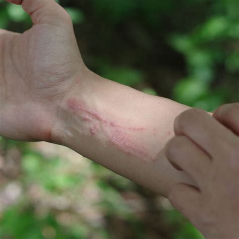 Poison Ivy Treatment Baking Soda