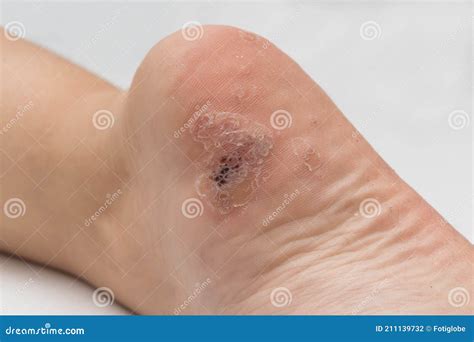 Plantar Wart Close Up on the Bottom of Foot Heel Caused by the Human Papillomavirus, or HPV ...