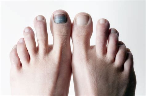 What Does A Bruise Under The Toenail Mean at Odessa Francis blog