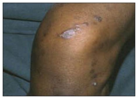 Hepatitis C Skin