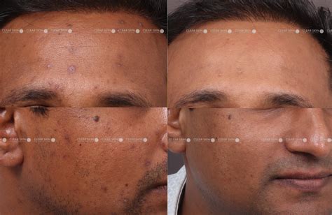 Mild Chicken Pox Face Chickenpox Scars: Causes, Treatment Options, And