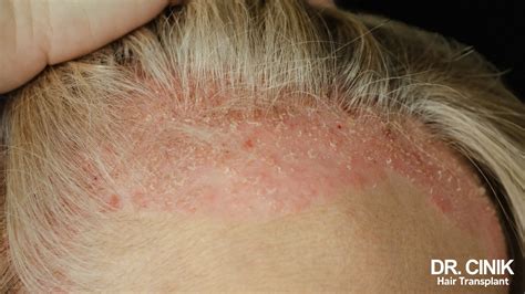 Mild Scalp Psoriasis