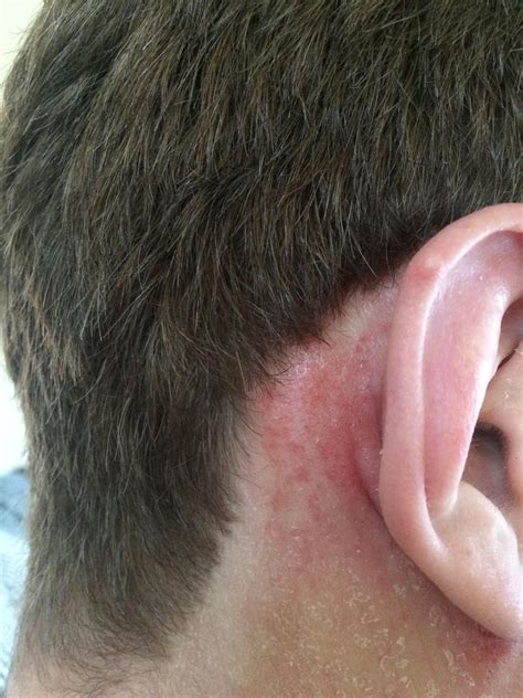 Eczema Behind Ears