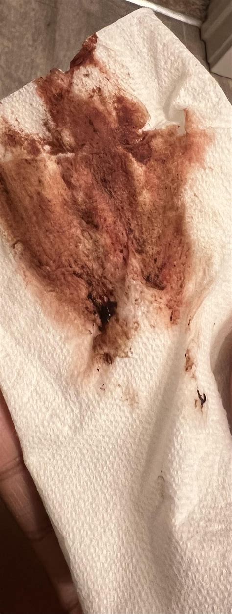 *Warning Graphic: Heavy Bleeding and Golf Ball Sized Blood Clot in ...