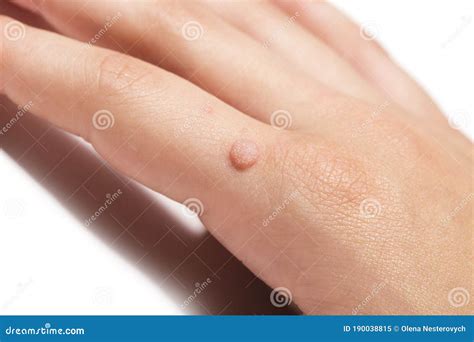 Common Wart Verruca Vulgaris a Flat Wart Commonly Found on the Hand of ...