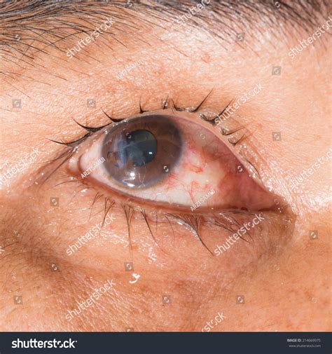 Ruptured Globe Eye