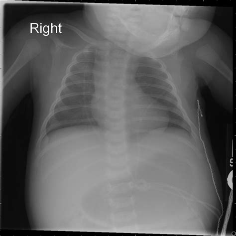 Tetralogy of Fallot - The Clinical Advisor