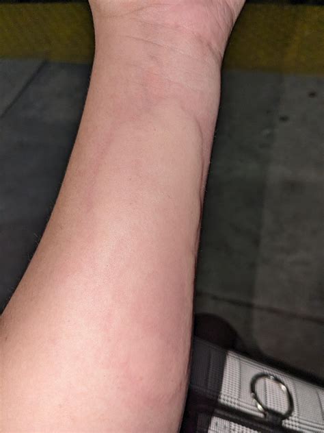 Hi , this happened to me after holding a cold drink in my arm walking to a train, and I was ...