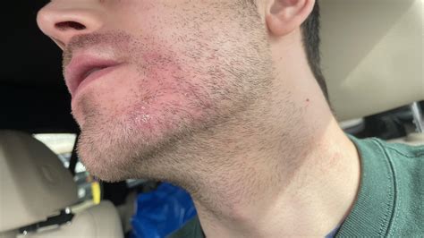 Perioral Dermatitis? Gram Negative Folliculitis? Tinea Barbae? What is ...