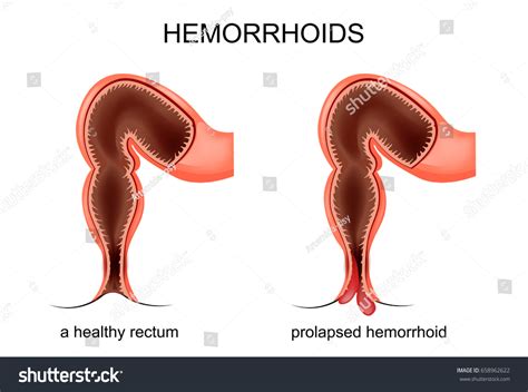External Hemorrhoid Vs Prolapse at Brant Roberts blog