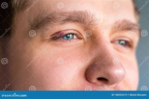 Selective Focus on Swollen and Painful Red Upper Eye Lid with Onset of Stye Infection Due To ...