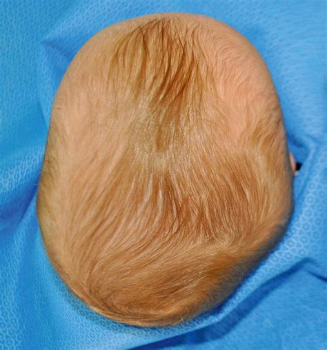 Lambdoid Craniosynostosis - Clinical Tree