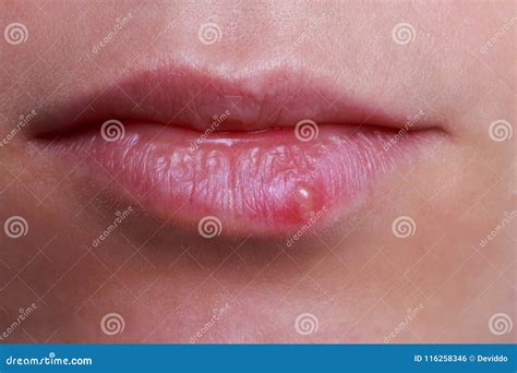Herpes Lips