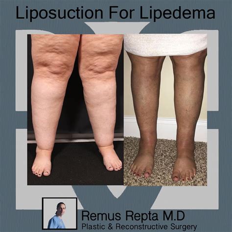 Liposuction for Lipedema IG- @drrepta_plasticsurgery | Plastic and reconstructive surgery ...