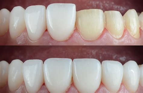 Front Tooth Root Canal Before And After Before & After Photos | Root