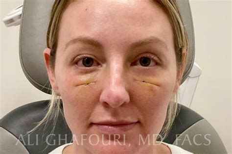 Lower Blepharoplasty Before and After | Dr. Ali Ghafouri