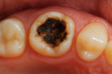 Tooth Decay Symptoms: From Early Warning Signs to Severe Stages