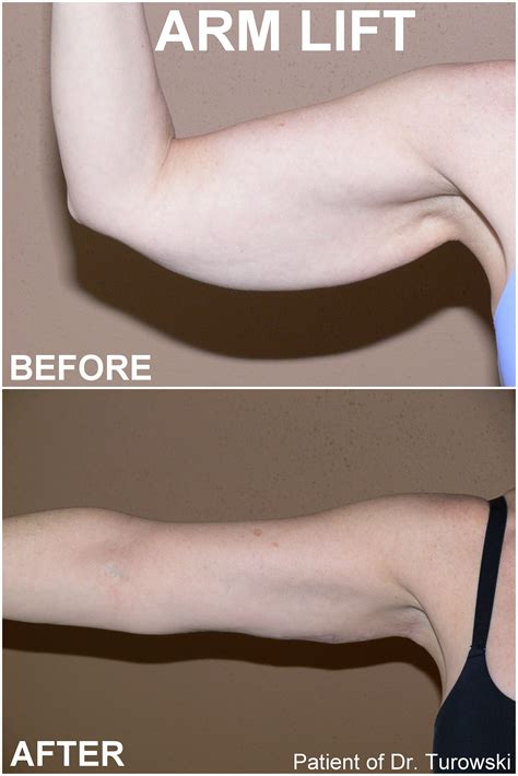 Arm Lift Surgery Glasgow at Zoe Nanya blog