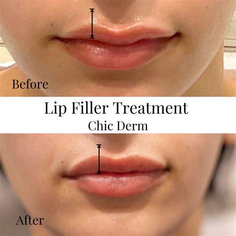 M Shaped Lip Augmentation (2) - Chic Med Spa in Allen - Dermatology ...
