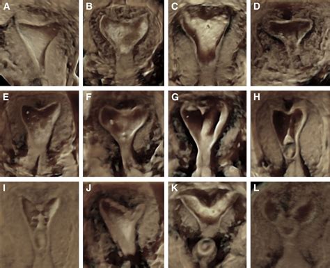 Diagnostic accuracy of three-dimensional sonohysterography compared with office hysteroscopy and ...