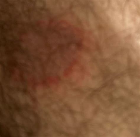 What is the itchy rash in my inner thigh? : r/HealthQuestions