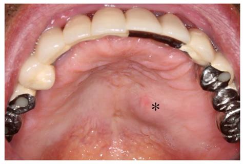Oral Mucocele Burst at Benjamin Whitley blog