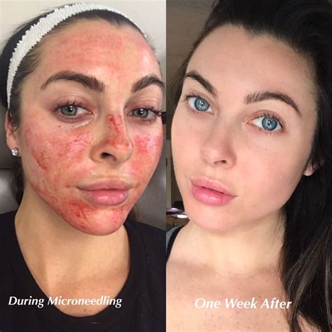 7 Microneedling ideas | microneedling, skin, skin care routine