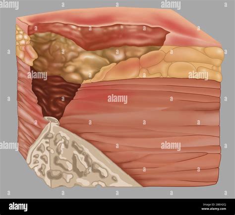 Stage 4 of a Bedsore, Illustration Stock Photo - Alamy