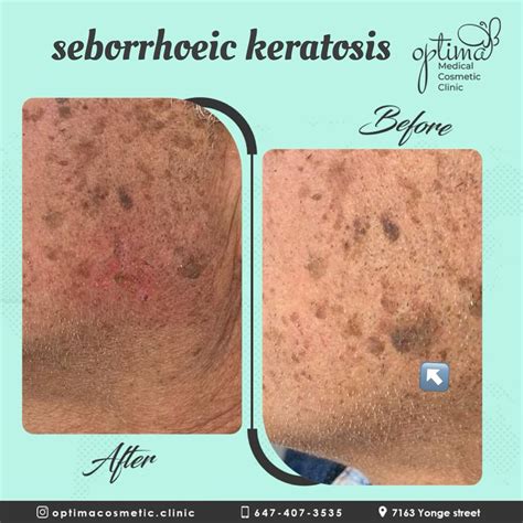 Seborrheic Keratosis: Treatment and Care - by Optima Medical Cosmetic Clinic
