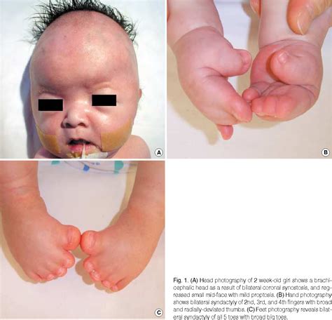 Pfeiffer Syndrome: Types, Causes And Treatments – DISKG