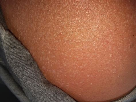 I got sunburned. Sweat is stuck under the peeling skin. They're all over my shoulders. So much ...