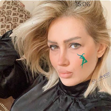 Facial Feminization Surgery - Dr. MFO in Turkey