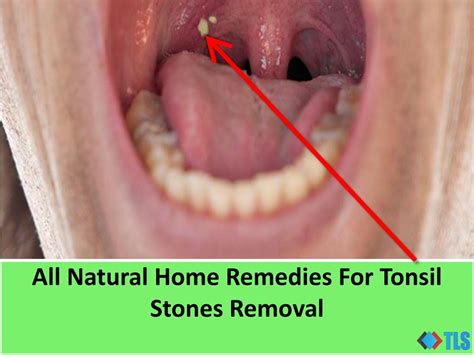 White Spots On Tonsils Stones