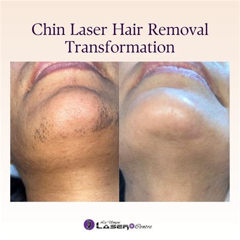 Laser Hair Removal Chin