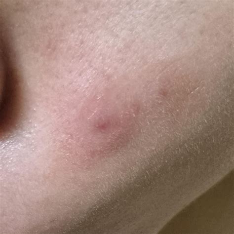 Help me solve this mystery! (blind pimple?!) : r/acne