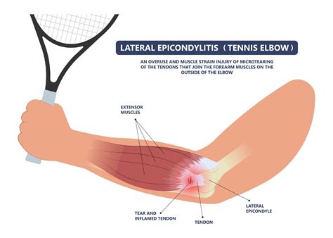 Tennis Elbow