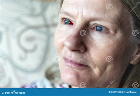 Subconjunctival Hemorrhage in the Right Eye of a Middle Aged Woman, at Her Home,Worcestershire ...