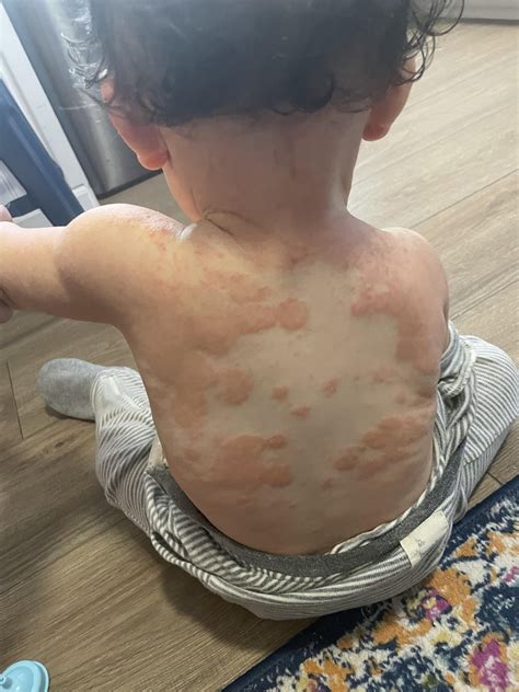 Eczema or ring worm? : r/DermatologyQuestions